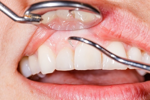 Can you get braces with gum disease & periodontal disease.