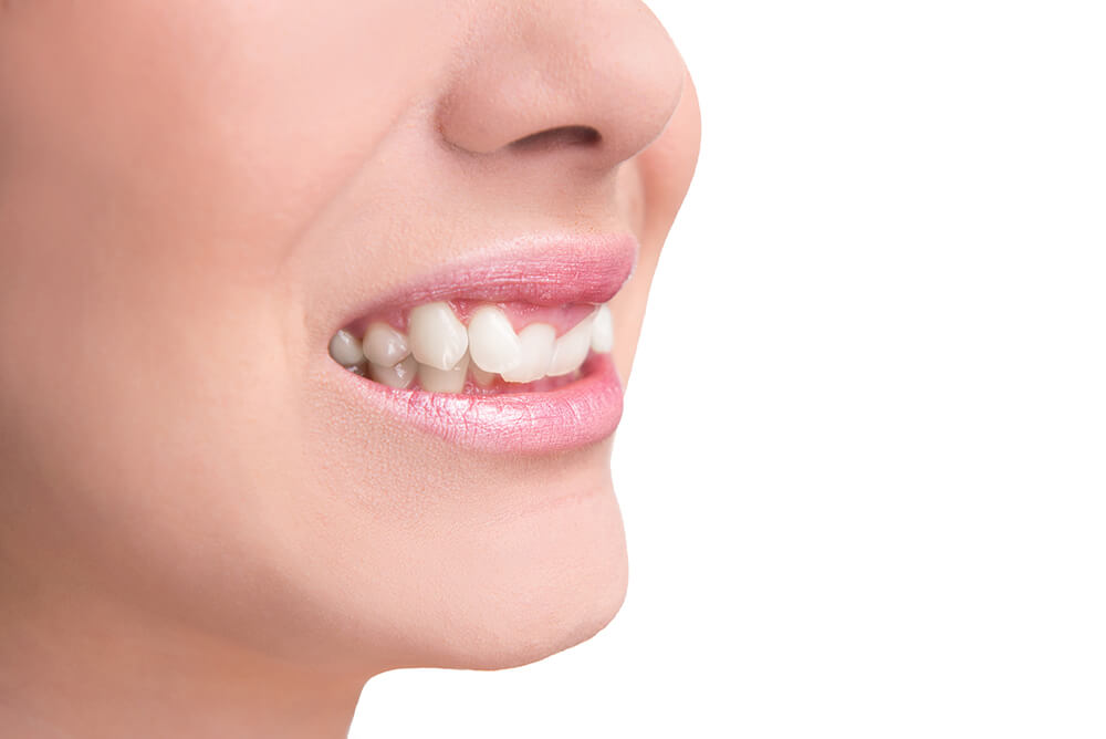 What is an Overbite and how easy is it to fix? - Clear Smiles