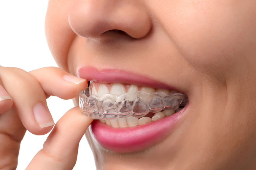 invisalign cons pros braces dental