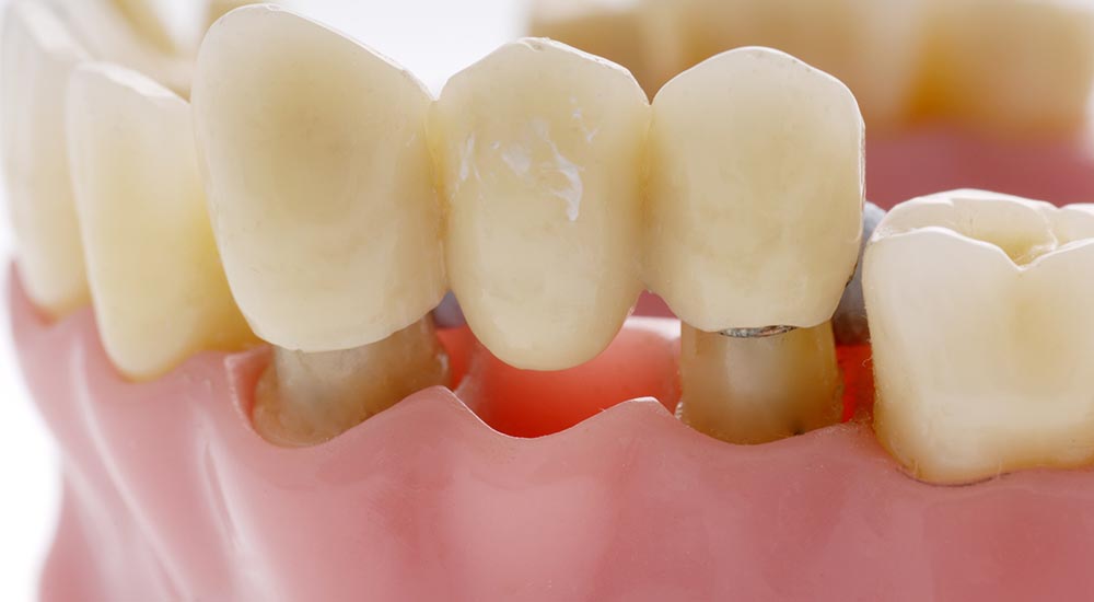 Affordable Dental Bridges In Las Vegas Absolute Dental 