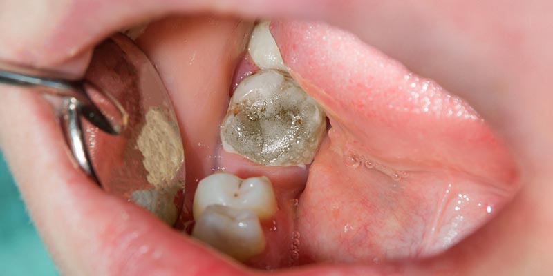 Causes And Treatments For A Dead Tooth Absolute Dental