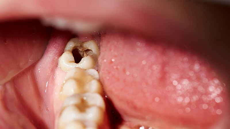 do cavities cause pain