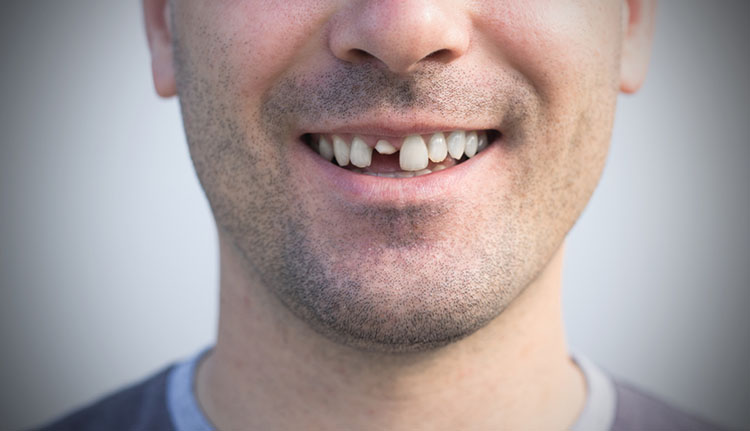 What To Do If You Chipped Or Broke A Tooth Absolute Dental