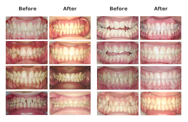 How Much Do Braces Cost With and Without Insurance?
