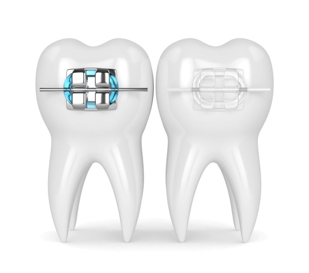 https://www.absolutedental.com/wp-content/uploads/2020/03/concept-image-metal-braces-vs-clear-ceramic-braces-1054w-1024x905.jpg