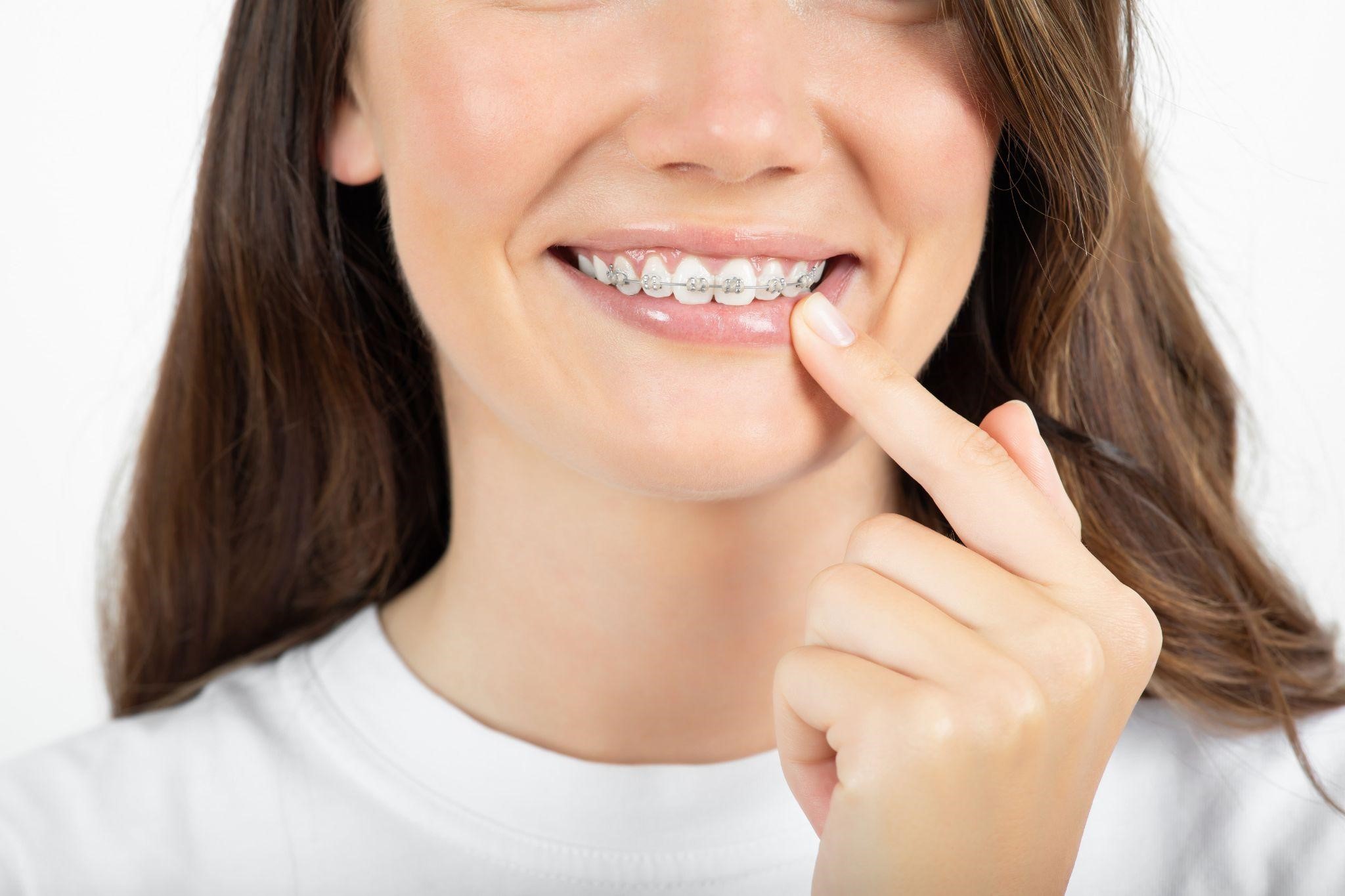 7 Things To Know About Adult Braces - Types, Treatment, Options