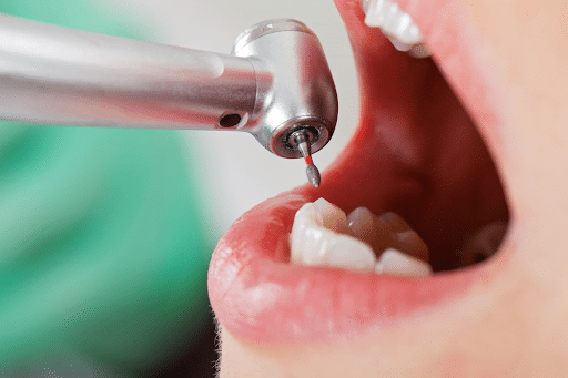 close up of a mouth with a dental drill