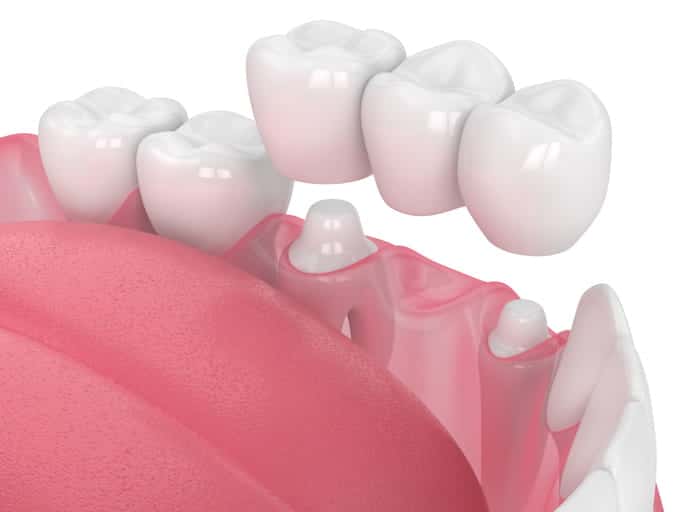 A 3D rendering of a dental bridge.