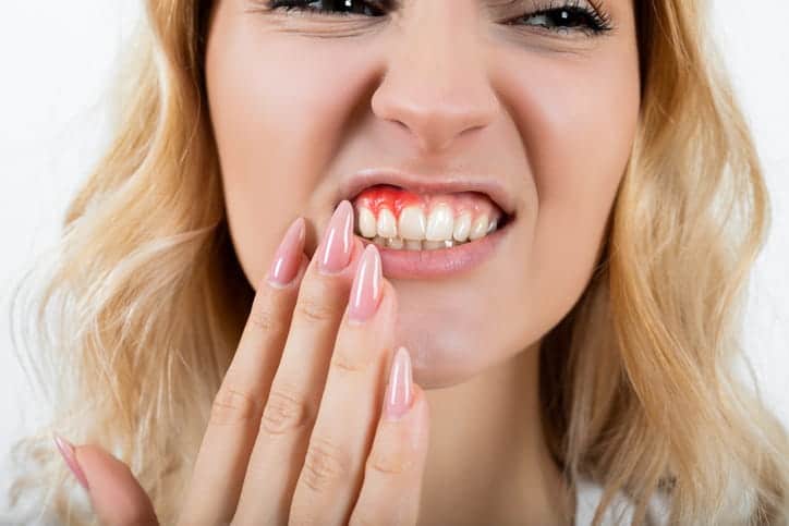 A woman in pain and showing her inflamed gums.
