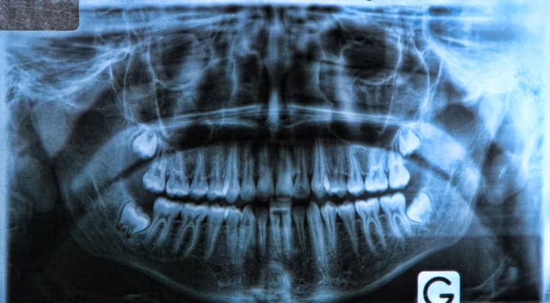 An X-ray of impacted wisdom teeth. 