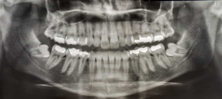 An X-ray of impacted wisdom teeth.
