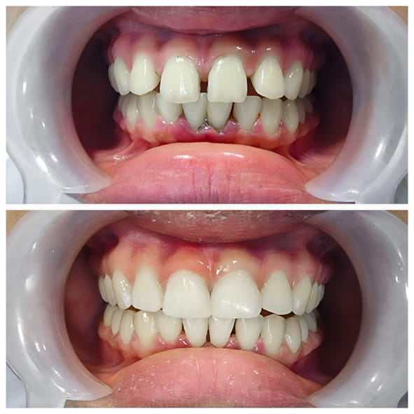 Photos of dental bonding before and after.