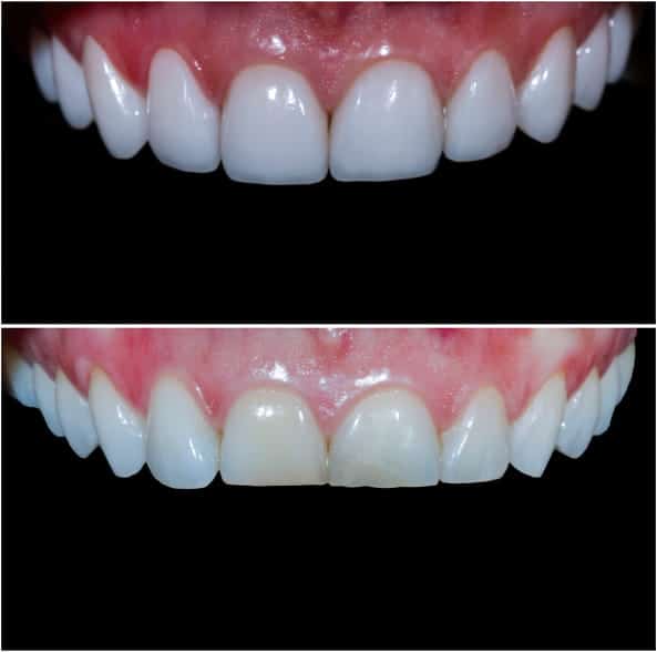 Teeth reshaping before and after photos with ceramic crowns and veneers.