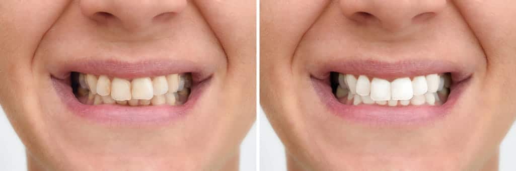 Photos of dental bonding before and after.