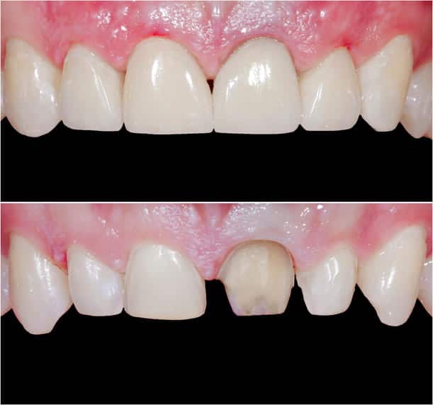 Teeth reshaping before and after photos with ceramic crowns and veneers.