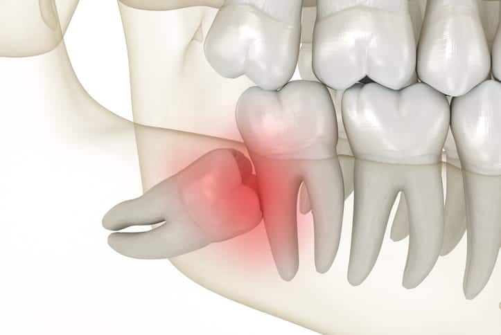 A 3D rendering showing an impacted wisdom tooth.