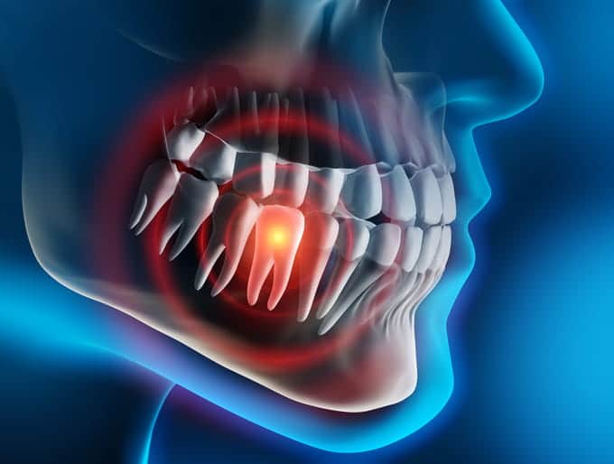 A 3D rendering of a dental emergency where a tooth is lit up in red.