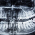 An X-ray showing impacted wisdom teeth.