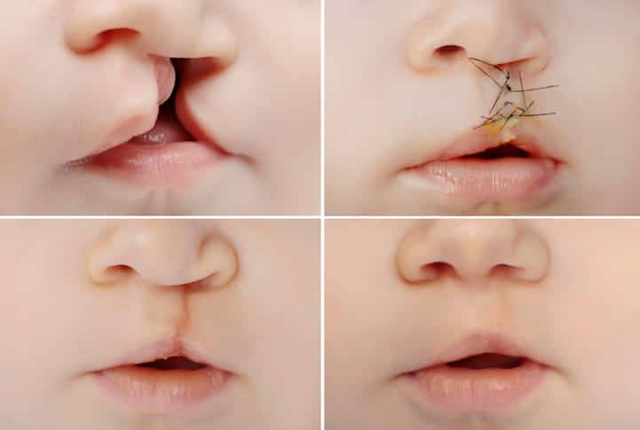 Four stages of cleft lip surgery: 1 - the cleft lip 2 - stitches after surgery 3 - the scar from the cleft lip surgery 4 - the skin healed after time