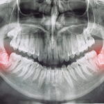 An X-ray showing impacted wisdom teeth.