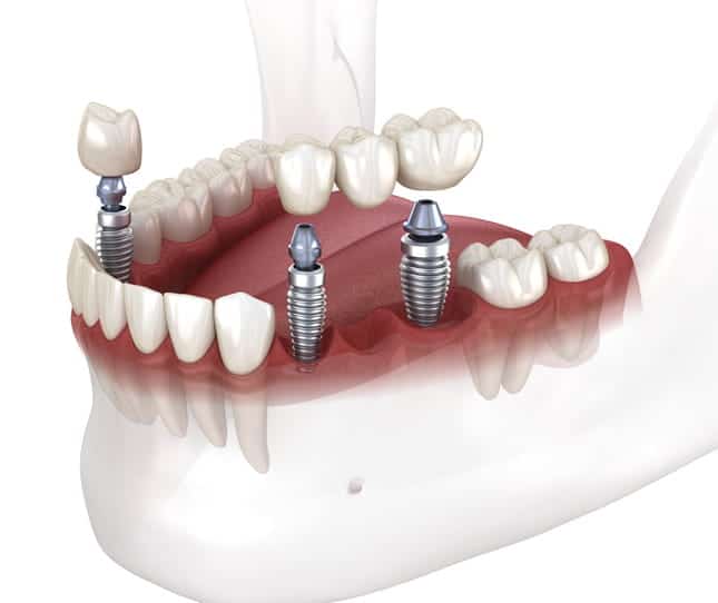 A 3D rendering of a dental implant-supported bridge.