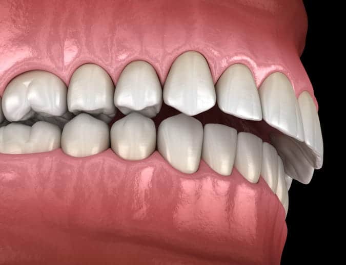 A 3D rendering of an overbite.