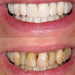 A before and after shot of a person's smile after they received veneers.