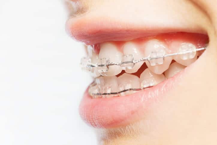 Focus is on a person smiling as they show off their clear braces.