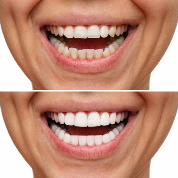 Before and after porcelain veneer treatment.