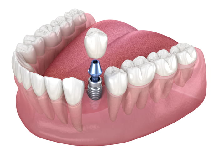 A 3D graphic of a dental implant.