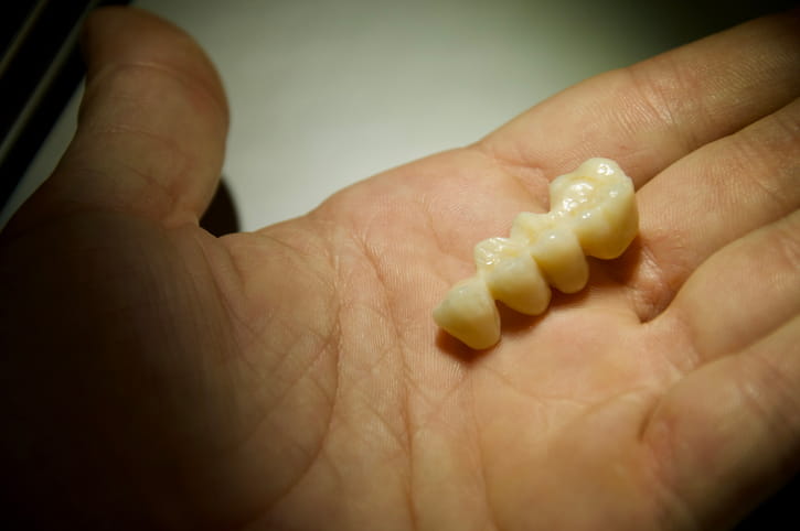 A person holding a dental bridge that shows four false teeth.